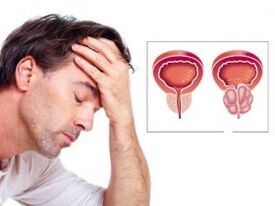 Prostatitis in men