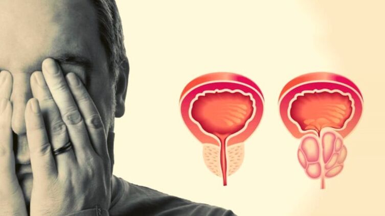 A man suffers from prostatitis