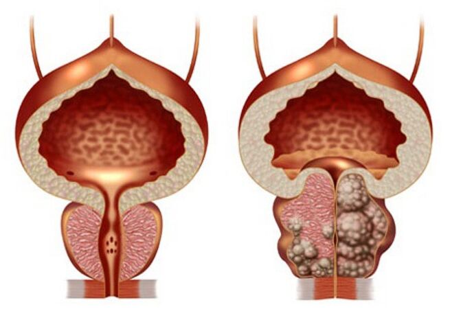 Healthy prostate and prostate adenomas