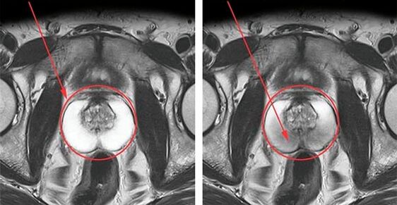 Normal prostate (left) and prostatitis with prostatitis (right)